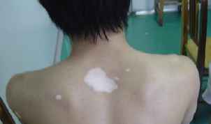 白癜风的治疗要点是什么